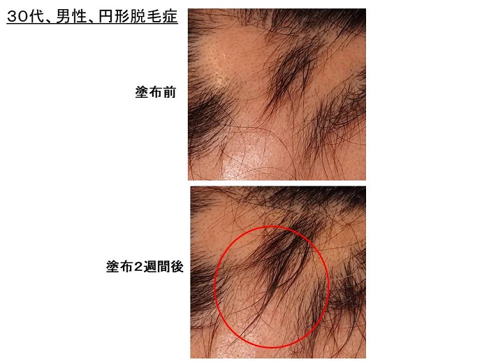 円形脱毛症　病院""